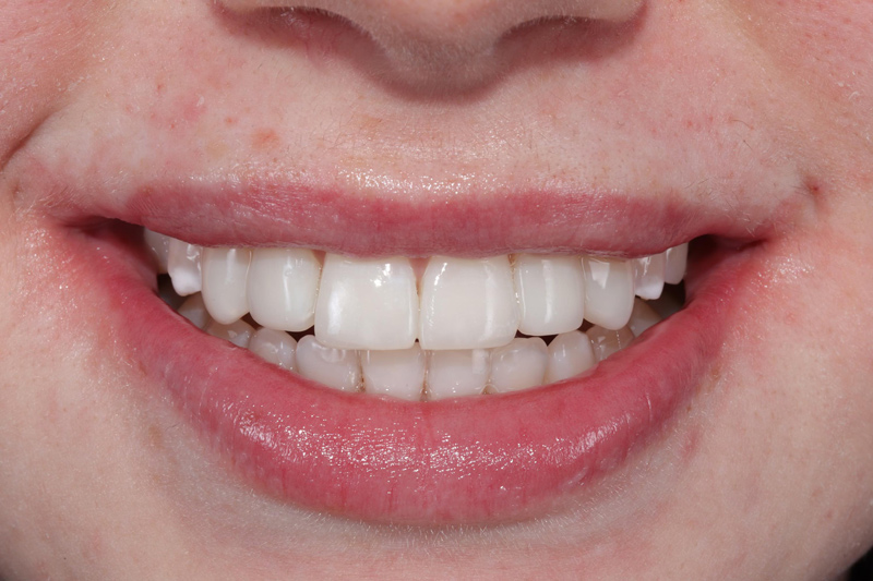 ABB Treatments in Wilmslow | Knutsford Road Dental Clinic gallery image 2