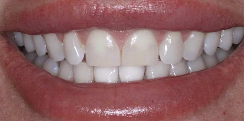 Composite Veneers in Wilmslow | Knutsford Road Dental Clinic gallery image 1