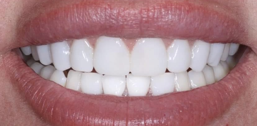 Composite Veneers in Wilmslow | Knutsford Road Dental Clinic gallery image 2